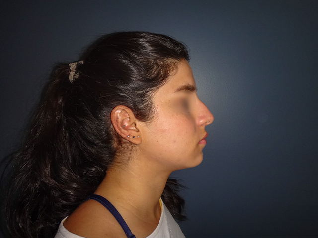 Antes